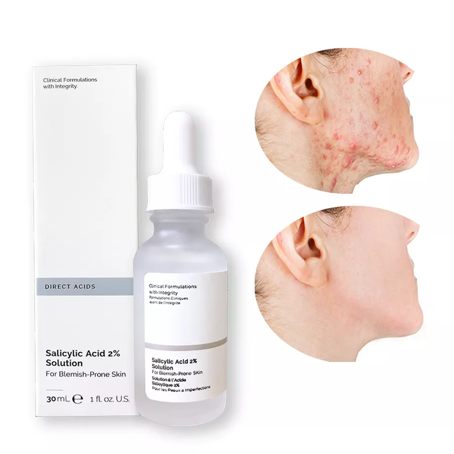 serum acne